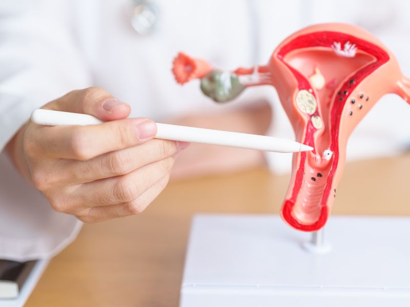 Loãng xương sau mãn kinh do nồng độ estrogen giảm mạnh