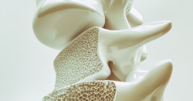 Tác hại của bệnh loãng xương