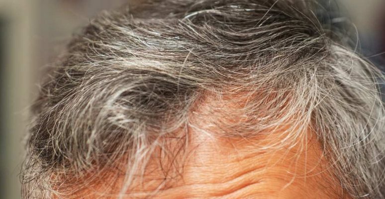 35 tuổi tóc bạc nhiều: Nguyên nhân và cách khắc phục hiệu quả