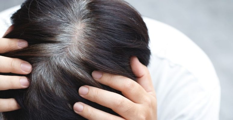 Tóc bạc nhiều: Nguyên nhân gây bạc tóc sớm ít ai biết