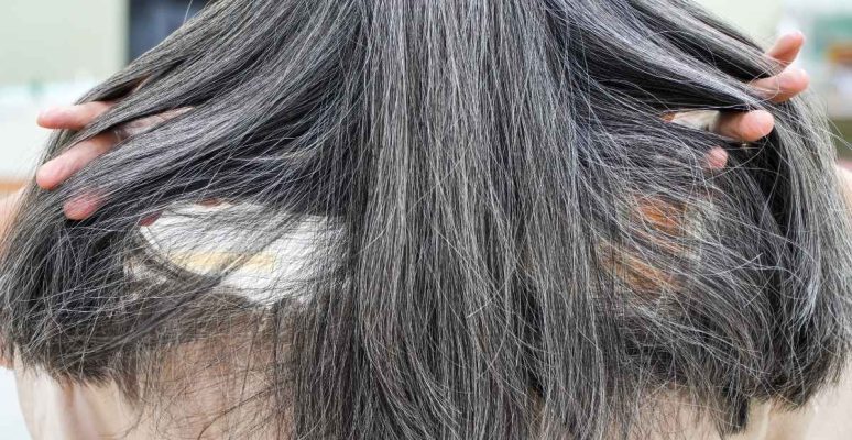 Tóc bạc sớm ở tuổi 30: Nguyên nhân và giải pháp hiệu quả nhất